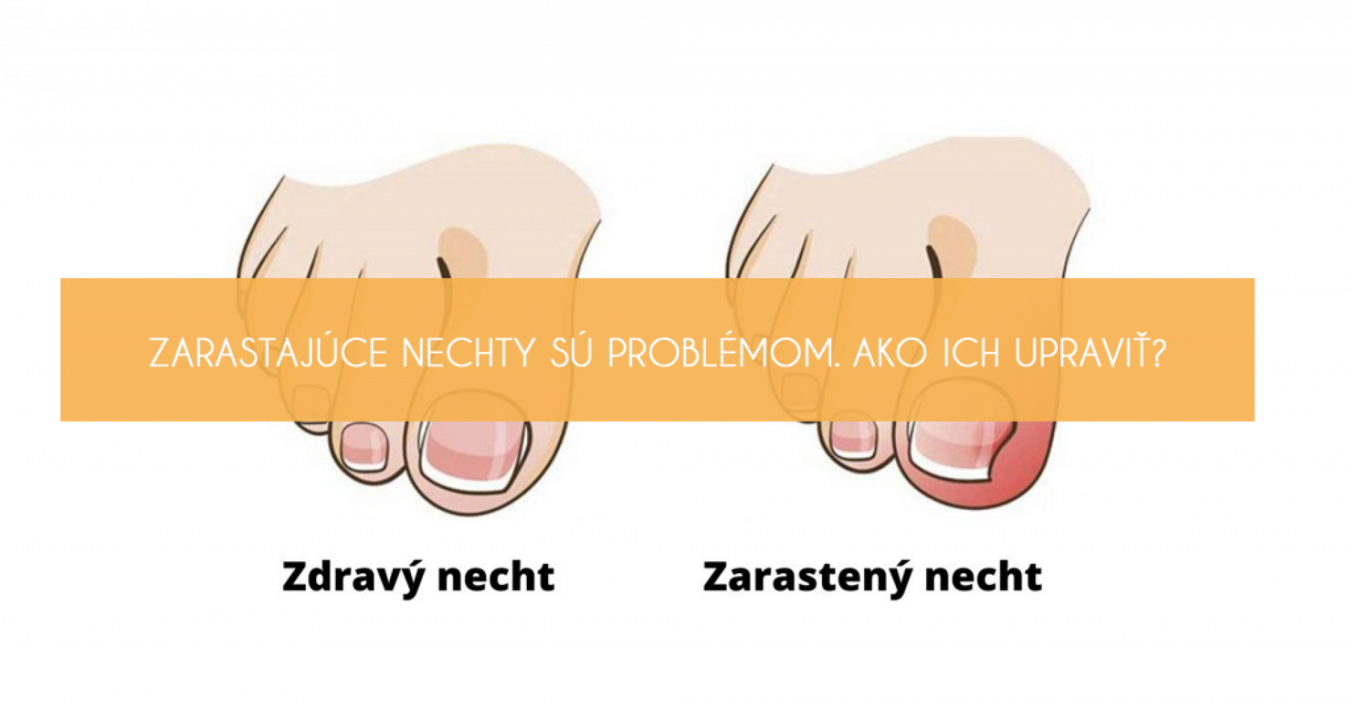 Zarastajúce nechty sú problémom. Ako ich upraviť?